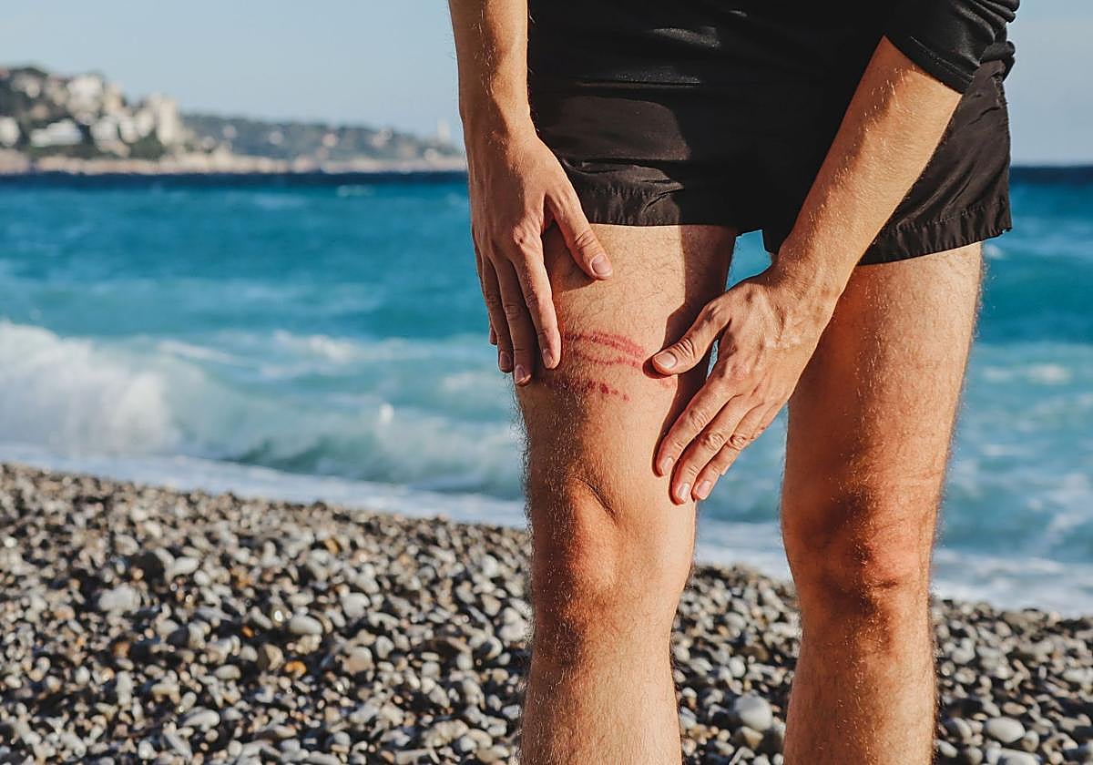 Qué hacer si te pica una medusa