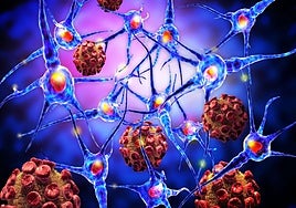 Un estudio de la Universidad de Harvard apunta a la deficiencia de litio como clave en el alzhéimer