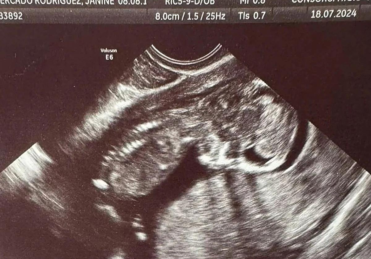 Ecografía de la pequeña Escarlett facilitada por su abuela.