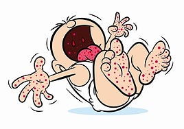 Boca-mano-pie, la enfermedad que vacía las escuelas infantiles cada otoño