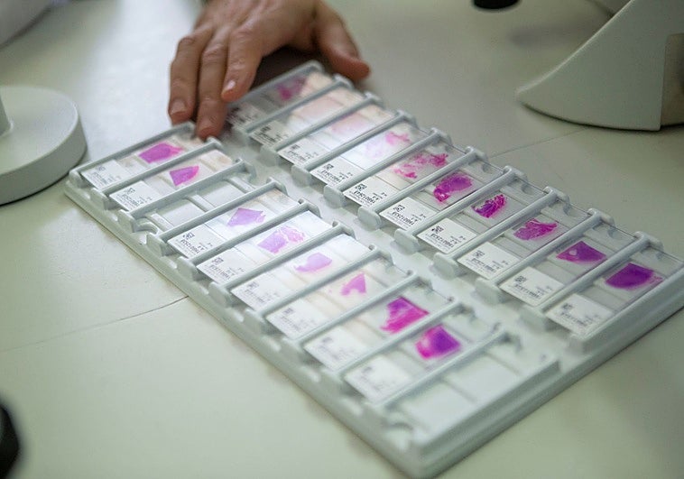 La difícil ruta de salvación para el paciente con sarcoma, un cáncer raro y mortal