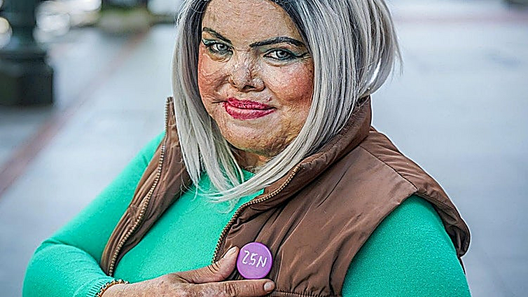 «Mi pareja me quemó, pero sigo viva y quiero ayudar a otras»