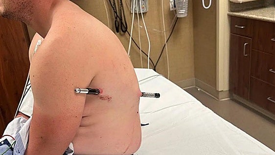 Un senderista con un bastón atravesado camina durante seis horas por miedo a la factura del rescate
