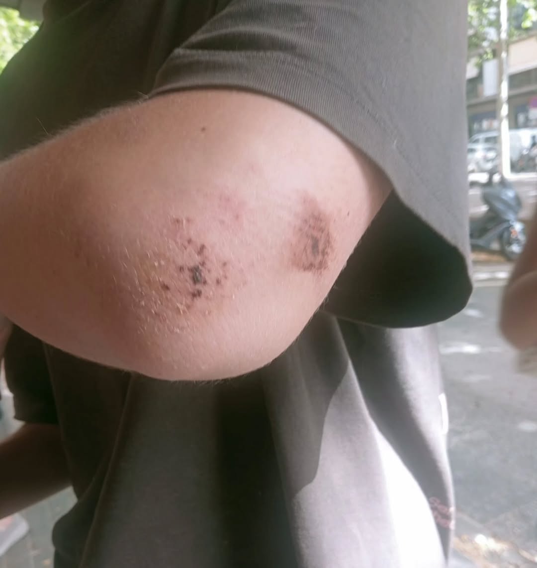 Herida del menor agredido en Mataró