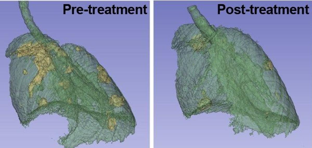 La proteína SOS1, identificada como nueva diana terapéutica en un cáncer de pulmón