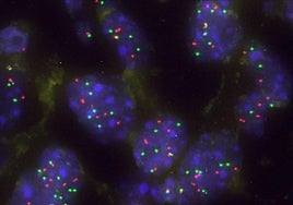 Imagen de un grupo de células tumorales pulmonares con aumento de KRAS para superar la barrera natural Capicua.