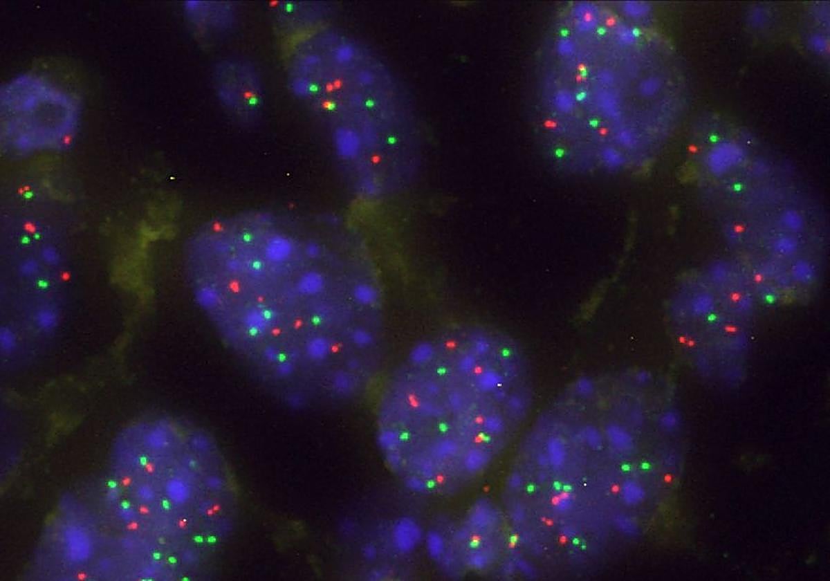 Imagen de un grupo de células tumorales pulmonares con aumento de KRAS para superar la barrera natural Capicua.