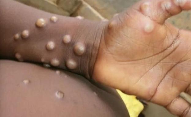 Ministry of Health issues warning about monkeypox virus in Spain after eight suspected cases detected 