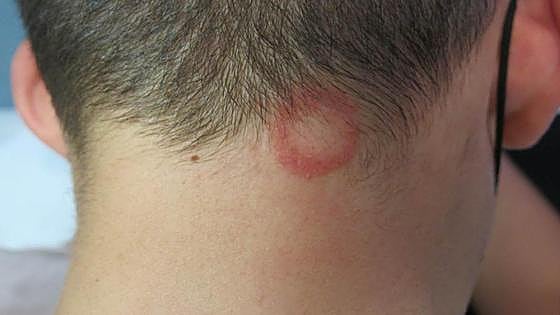 Cases of scalp ringworm caught at low-cost hairdressers, experts warn