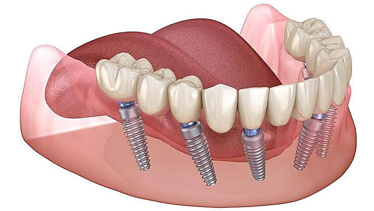 Harmonia Dental, fixed teeth in one day, a latest generation treatment