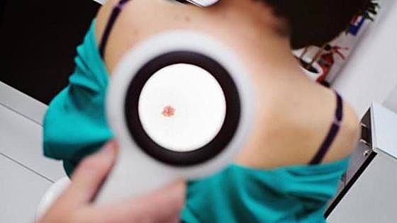 Skin cancer clinic screening day