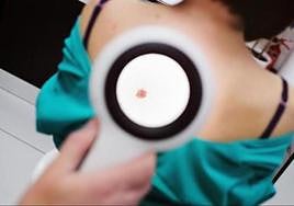 Malaga university researchers develop tool based on artificial intelligence to improve detection of melanomas