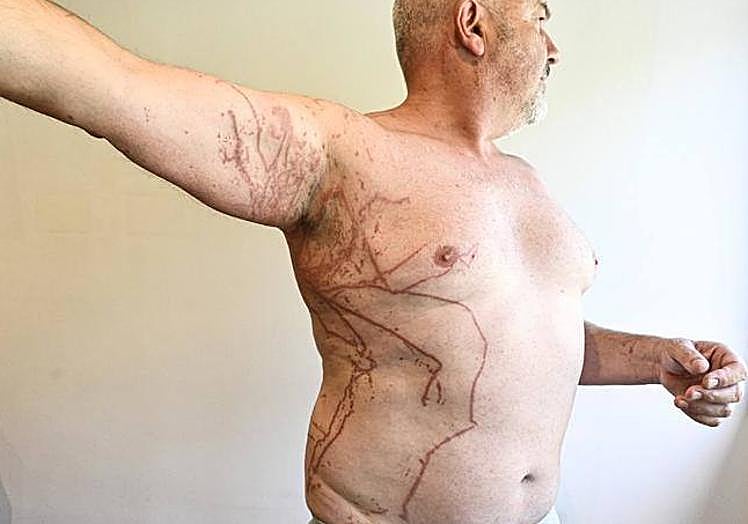 Imagen principal - The sting of a Portuguese man o' war: 'It was one of the worst days of my life and at times I thought I was going to die'