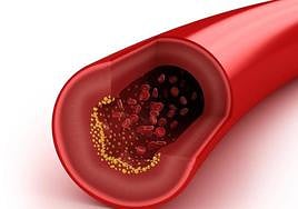 Cholesterol in an artery, in a 3D image.