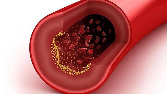 New cholesterol treatment arrives in Spain with two jabs a year to help reduce it
