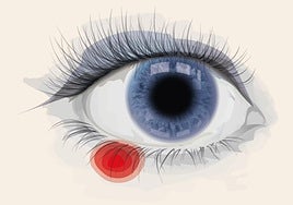 Styes: a painful but not serious eye infection