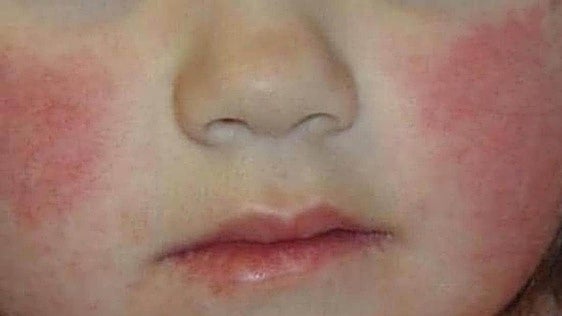 Malaga records huge increase of slapped cheek syndrome cases