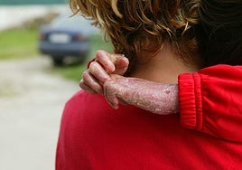 A child with Epidermolysis bullosa.