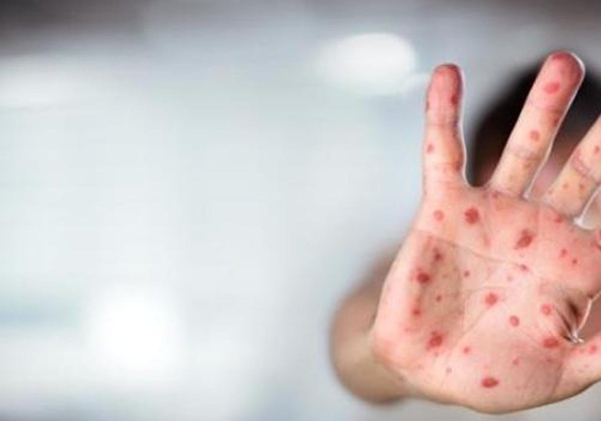 Majority of measles cases in Andalucía were detected in Malaga, with half of them requiring hospitalisation
