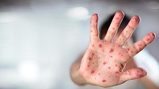 Majority of measles cases in Andalucía were detected in Malaga, with half of them requiring hospitalisation