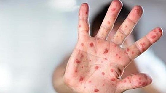 Measles vaccination brought forward in Costa del Sol municipalities affected by recent outbreaks