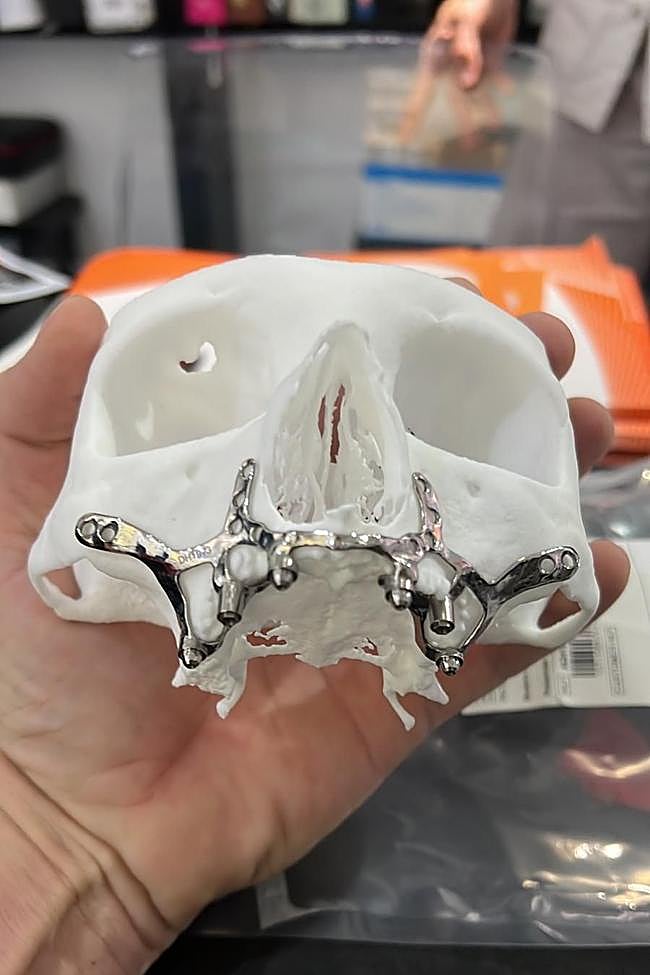 An example of a mesh used in subperiosteal implants.