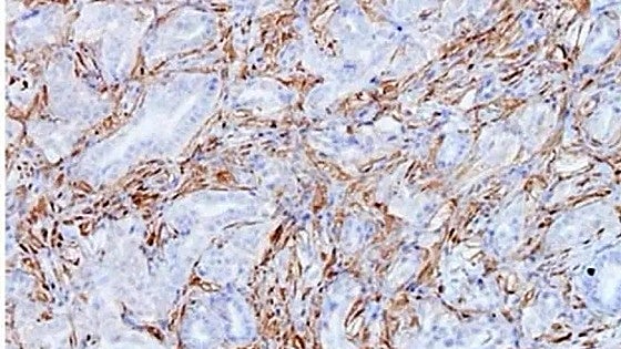 Spanish study identifies one new reason why pancreatic cancer is so aggressive