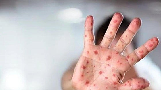 Junta does not rule out new outbreaks of measles in Andalucía