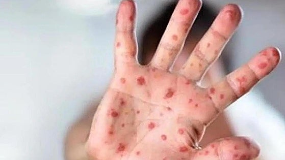 EU warns of rise in measles cases due to falling vaccination rates