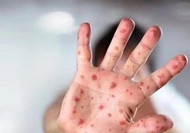 A person infected with measles.