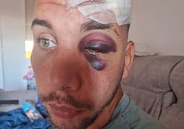 Hit-and-run victim searches for driver that left him seriously injured after knocking him off electric scooter in Benalmádena
