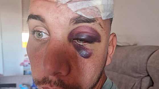 Hit-and-run victim searches for driver that left him seriously injured after knocking him off electric scooter in Benalmádena