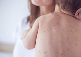 New case of measles confirmed in six-month-old child on eastern Costa del Sol