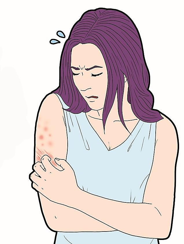 Chronic urticaria: how to live with hives and itching on a daily basis