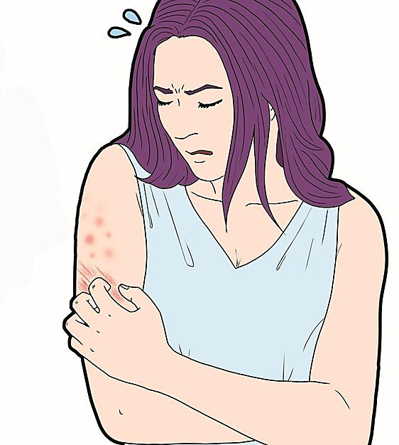 Chronic urticaria: how to live with hives and itching on a daily basis