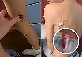 Images of the injuries to a minor's back and leg; in the round photo, the cut on the arm of the man who helped the children.