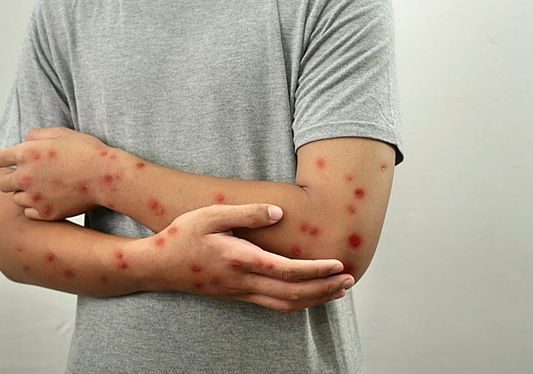 A measles patient.