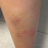 One of the injuries suffered by the child.