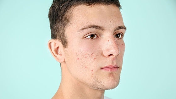 Adult acne: causes, treatments and mistakes to avoid