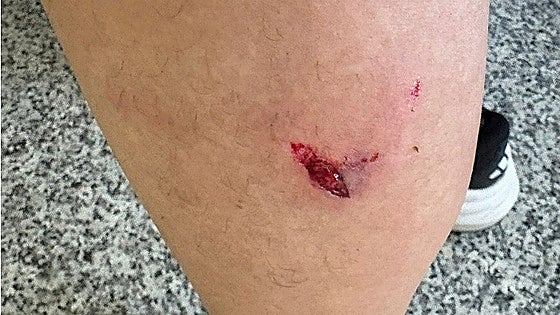 Dog bites a young man in Granada province's Guadix: 'If it had been a child or an elderly person, it would have killed them'
