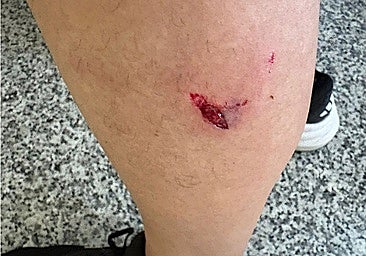 Dog bite on the leg of José, a resident of Guadix.