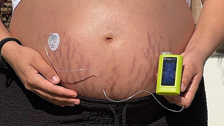 Malaga endocrinologist urges women to take measures against gestational diabetes
