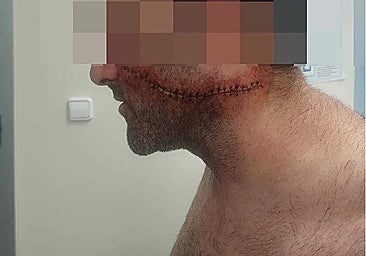Malaga healthcare worker with 30 stitches after having face slashed by stranger