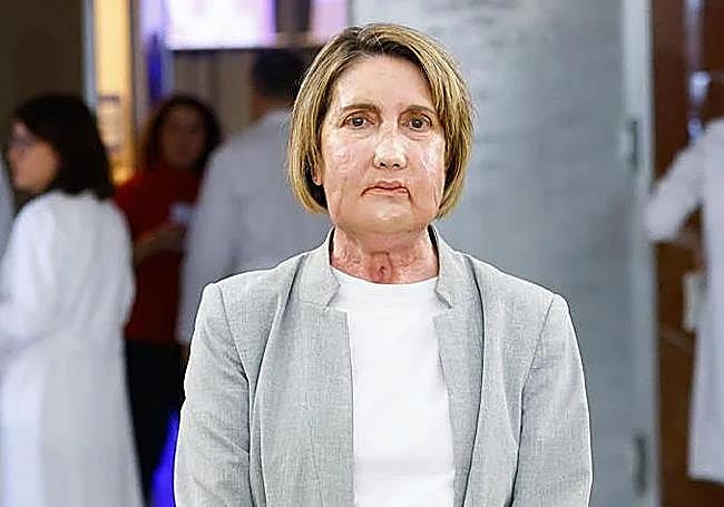 Five months after the operation, Vall d'Hebron presented Carmen’s case to the public. As well as her face, the surgeons reconstructed her toes, which she had lost due to the bacteria