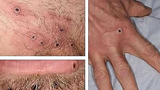 San Sebastián cancer patient dies after contracting mpox from hospital roommate