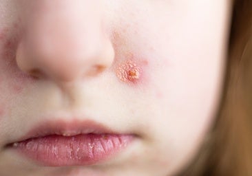 A child with impetigo.