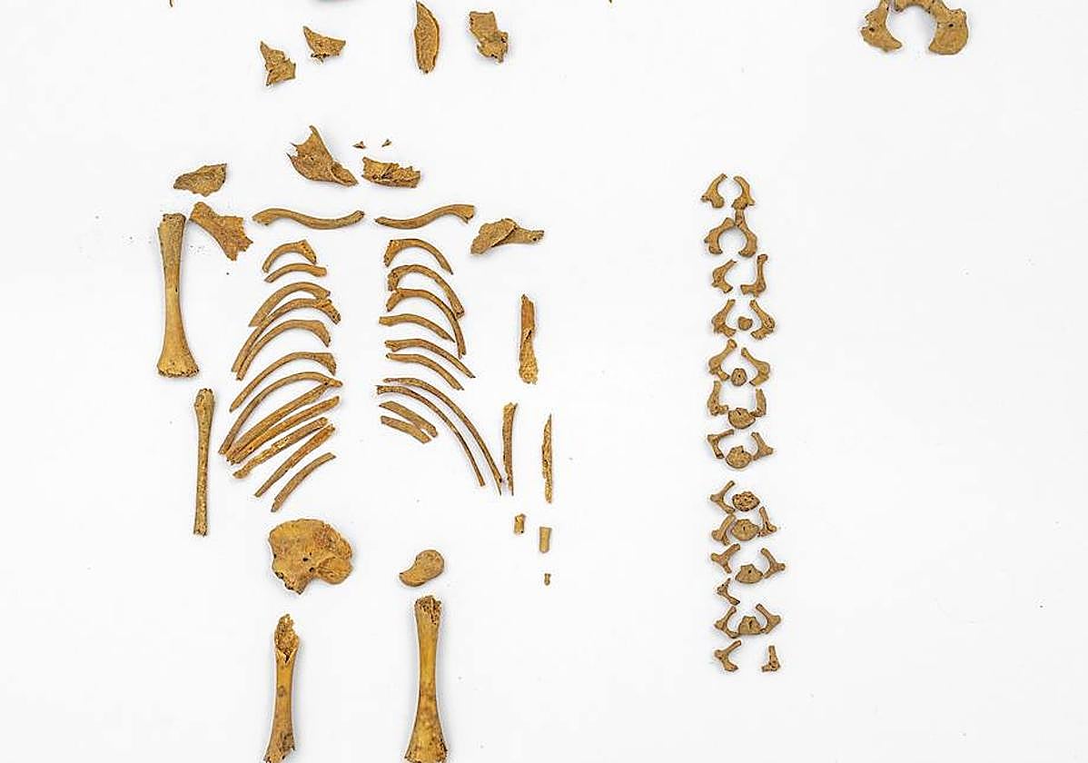 Esqueleto de un niño con síndrome de Down que murió en torno a las 26 semanas de edad gestacional.