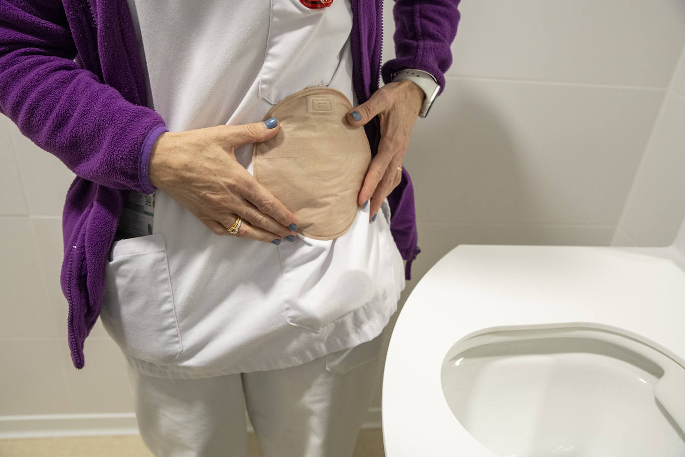 El Hospital de Sant Joan forma a sus enfermeras para el cuidado de pacientes ostomizados
