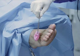 Una atención podológica temprana podría evitar hasta el 85% de las amputaciones por pie diabético.