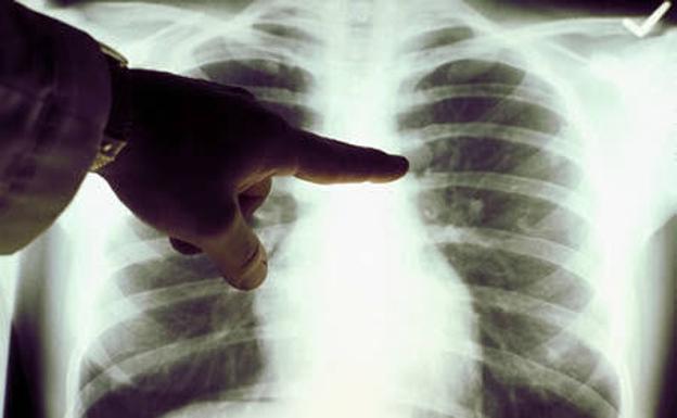 Un médico examina una radiografía de pulmones. 